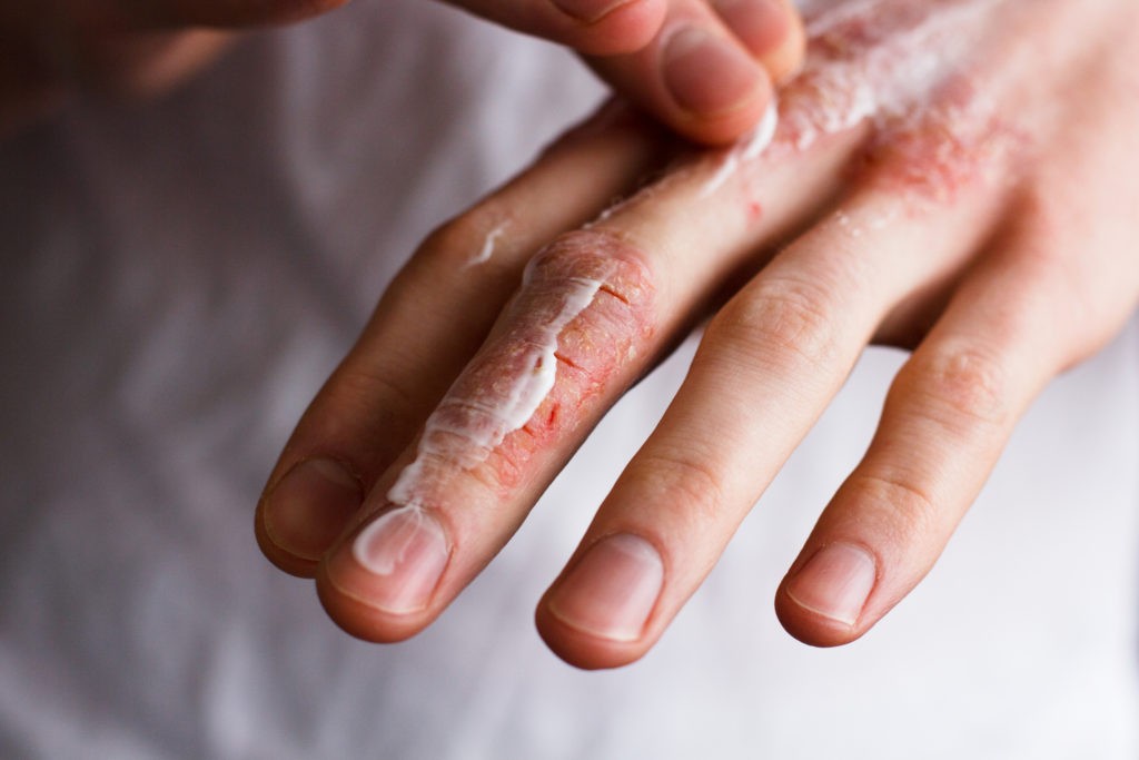 ragadi alle dita delle mani cosa sono sintomi cause e possibili cure
