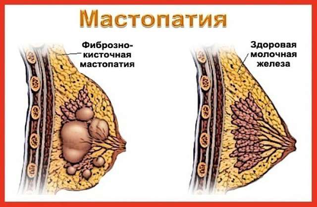 Мастопатия молочных желез. Симптомы и лечение мастопатии