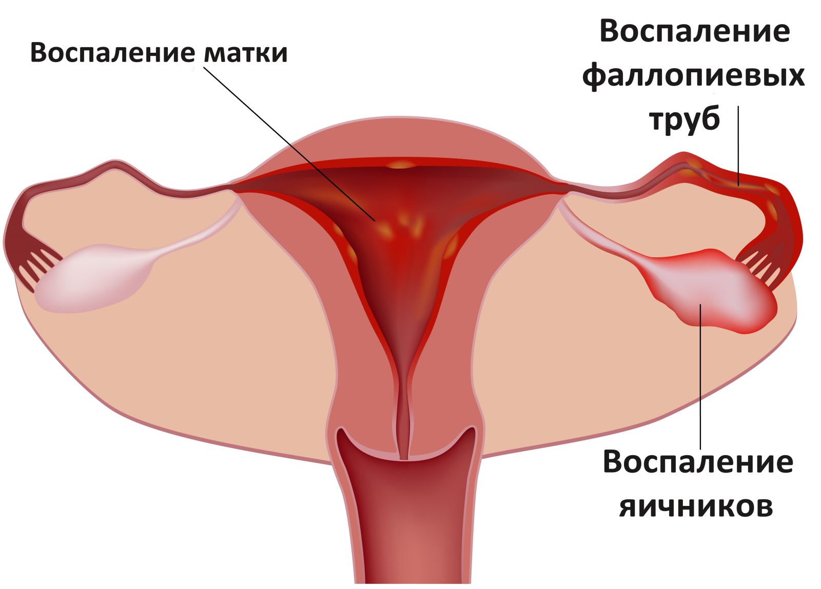 воспаление матки и придатков при хламидиозе у женщин
