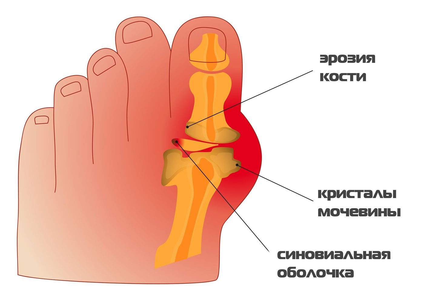 Причины болят пальцы на ногах почему. Воспаление сустава большого пальца на ноге. Подагра большого пальца стопы. Сустав большого пальца стопы.